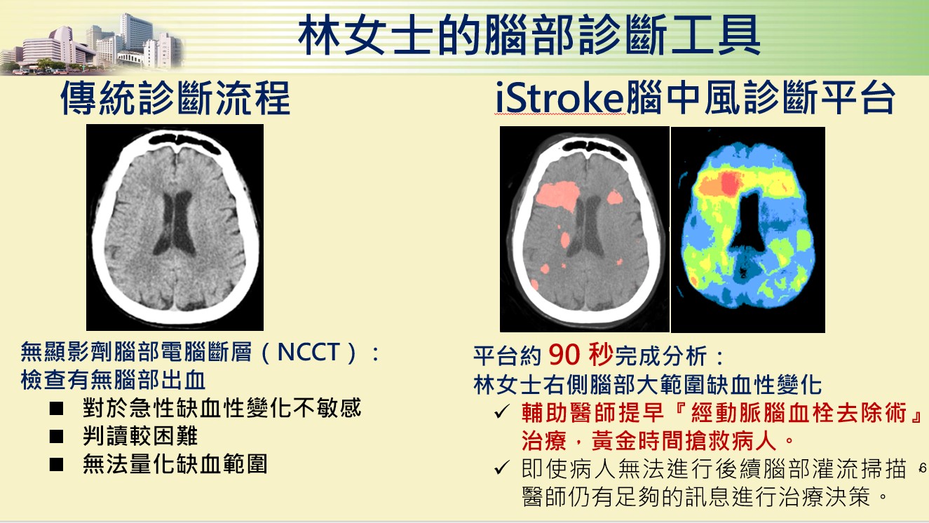 中國附醫「iStroke腦中風診斷平台」 CT免顯影劑90秒AI鎖定腦傷區與體積 | 蕃新聞