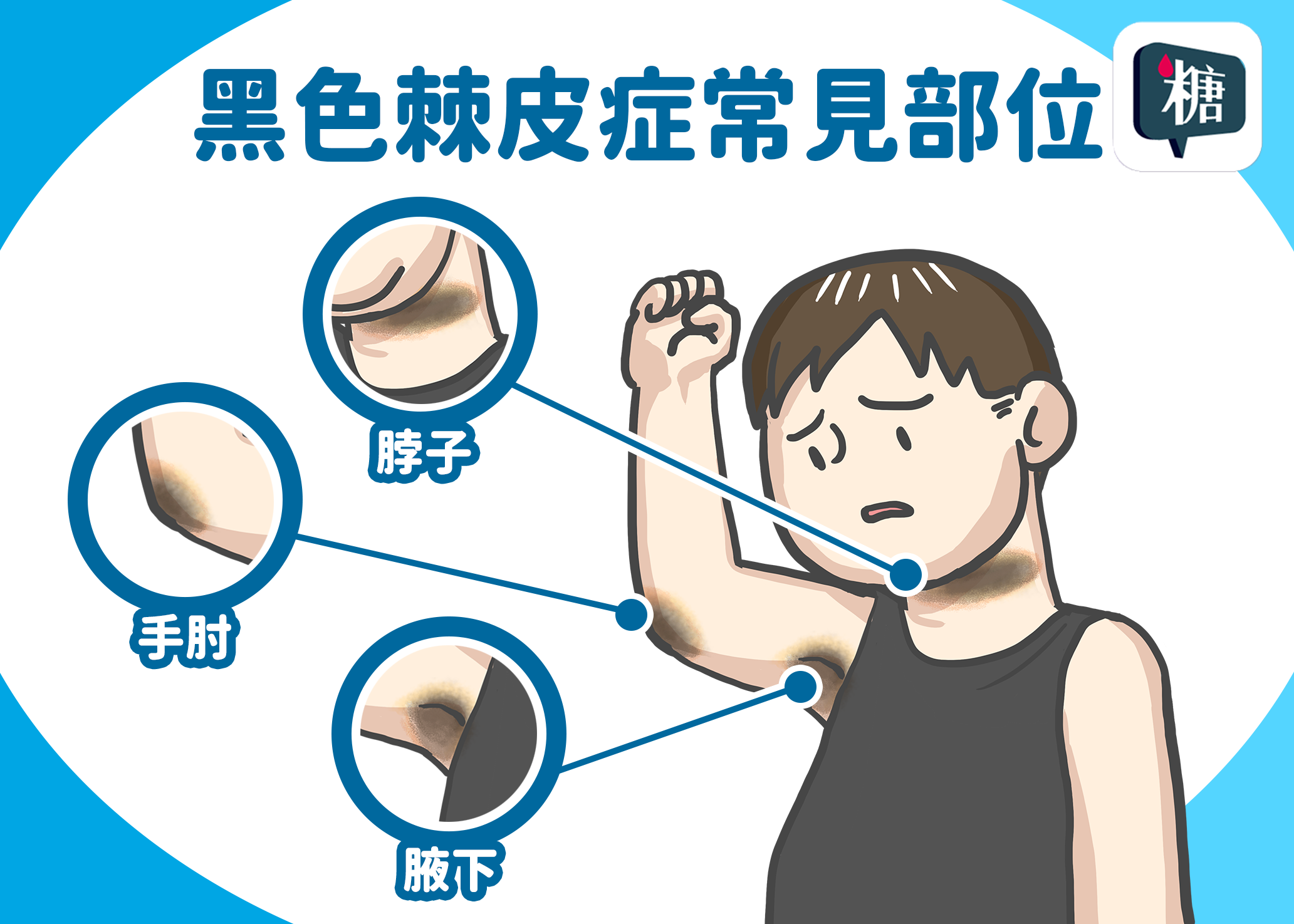 逆轉糖尿病前期有訣竅　醫：「減脂」、「增肌」、「控糖」關鍵3大招！