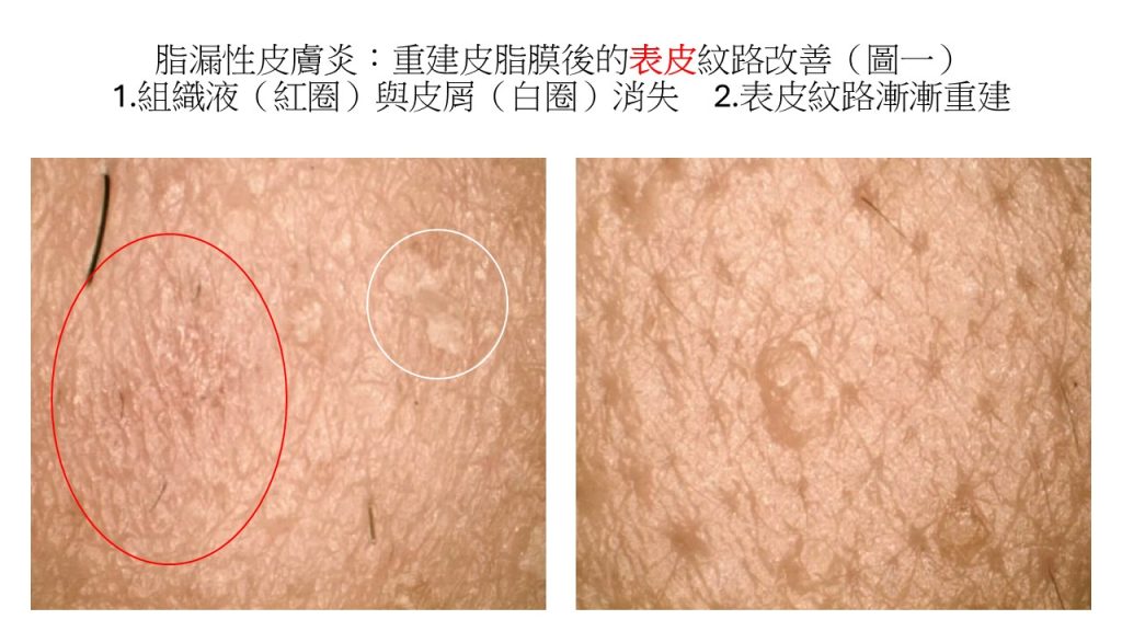 脂漏性皮膚炎新視角：從抑制黴菌到重建屏障