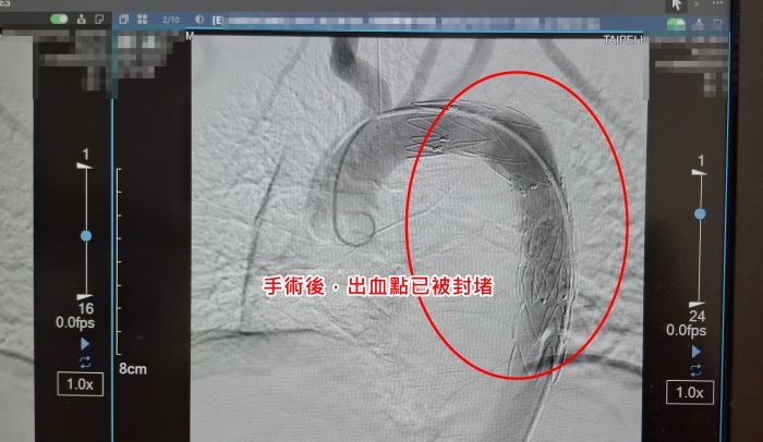 胸部鈍挫傷恐致主動脈破裂 醫:死亡率高達八成需及早診斷 8 《圖說》手術後,出血點已被封堵。〈臺北醫院提供〉